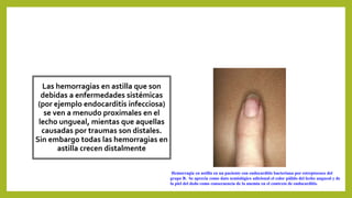 Las hemorragias en astilla que son
debidas a enfermedades sistémicas
(por ejemplo endocarditis infecciosa)
se ven a menudo proximales en el
lecho ungueal, mientas que aquellas
causadas por traumas son distales.
Sin embargo todas las hemorragias en
astilla crecen distalmente
Hemorragia en astilla en un paciente con endocarditis bacteriana por estreptococo del
grupo B. Se aprecia como dato semiológico adicional el color pálido del lecho ungueal y de
la piel del dedo como consecuencia de la anemia en el contexto de endocarditis.
 