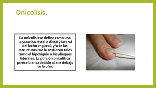 Onicolisis.
La onicolisis se define como una
separación distal o distal y lateral
del lecho ungueal, y/o de las
estructuras que la sostienen tales
como el hiponiquio o los pliegues
laterales. La porción onicolítica
parece blanca debido al aire debajo
de la uña.
 