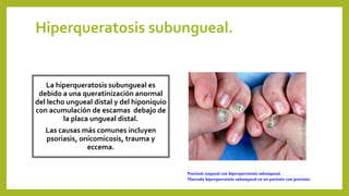 Hiperqueratosis subungueal.
La hiperqueratosis subungueal es
debido a una queratinización anormal
del lecho ungueal distal y del hiponiquio
con acumulación de escamas debajo de
la placa ungueal distal.
Las causas más comunes incluyen
psoriasis, onicomicosis, trauma y
eccema.
Psoriasis ungueal con hiperqueratosis subungueal.
Marcada hiperqueratosis subungueal en un paciente con psoriasis.
 