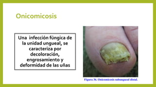 Onicomicosis
Una infección fúngica de
la unidad ungueal, se
caracteriza por
decoloración,
engrosamiento y
deformidad de las uñas
Figura 36. Onicomicosis subungueal distal.
 