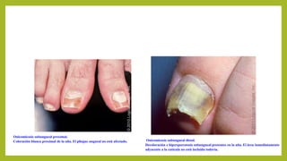 Onicomicosis subungueal distal.
Decoloración e hiperqueratosis subungueal presentes en la uña. El área inmediatamente
adyacente a la cutícula no está incluida todavía.
Onicomicosis subungueal proximal.
Coloración blanca proximal de la uña. El pliegue ungueal no está afectado.
 