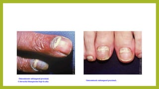 Onicomicosis subungueal proximal.
Coloración blanquecina bajo la uña.
Onicomicosis subungueal proximal.
 