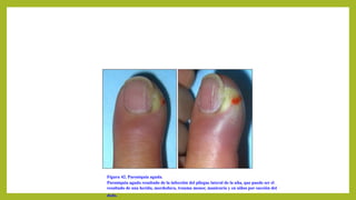 Figura 42. Paroniquia aguda.
Paroniquia aguda resultado de la infección del pliegue lateral de la uña, que puede ser el
resultado de una herida, mordedura, trauma menor, manicuría y en niños por succión del
dedo.
 