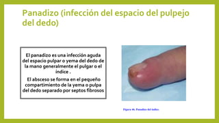 Panadizo (infección del espacio del pulpejo
del dedo)
El panadizo es una infección aguda
del espacio pulpar o yema del dedo de
la mano generalmente el pulgar o el
índice .
El absceso se forma en el pequeño
compartimiento de la yema o pulpa
del dedo separado por septos fibrosos
Figura 46. Panadizo del índice.
 