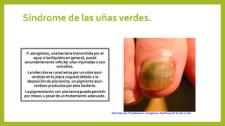 Síndrome de las uñas verdes.
P. aeruginosa, una bacteria transmitida por el
agua o los líquidos en general, puede
secundariamente infectar uñas injuriadas o con
onicolisis.
La infección se caracteriza por un color azul-
verdoso en la placa ungueal debido a la
deposición de piocianina, un pigmento azul-
verdoso producida por esta bacteria.
La pigmentación con piocianina puede persistir
por meses a pesar de un tratamiento adecuado.
Infección por Pseudomona. Aeruginosa. Síndrome de la uña verde.
 