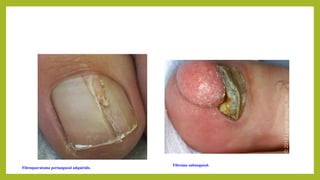 Fibroqueratoma periungueal adquirido.
Fibroma subungueal.
 