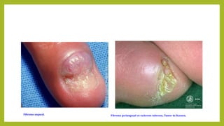 Fibroma ungueal. Fibroma periungueal en esclerosis tuberosa. Tumor de Koenen.
 