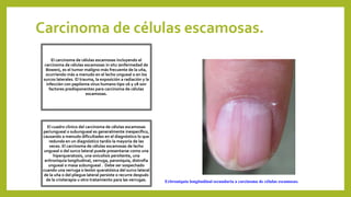 Carcinoma de células escamosas.
El carcinoma de células escamosas incluyendo el
carcinoma de células escamosas in situ (enfermedad de
Bowen), es el tumor maligno más frecuente de la uña,
ocurriendo más a menudo en el lecho ungueal o en los
surcos laterales. El trauma, la exposición a radiación y la
infección con papiloma virus humano tipo 16 y 18 son
factores predisponentes para carcinoma de células
escamosas.
El cuadro clínico del carcinoma de células escamosas
periungueal o subungueal es generalmente inespecífico,
causando a menudo dificultades en el diagnóstico lo que
redunda en un diagnóstico tardío la mayoría de las
veces. El carcinoma de células escamosas de lecho
ungueal o del surco lateral puede presentarse como una
hiperqueratosis, una onicolisis persitente, una
eritroniquia longitudinal, verruga, paroniquia, distrofia
ungueal o masa subungueal . Debe ser sospechado
cuando una verruga o lesión queratósica del surco lateral
de la uña o del pliegue lateral persiste o recurre después
de la crioterapia u otro tratamiento para las verrugas. Eritroniquia longitudinal secundaria a carcinoma de células escamosas.
 