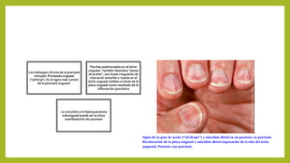 Los hallazgos clínicos de la psoriasis
incluyen: Punteado ungueal
(“pitting”). Es el signo más común
de la psoriasis ungueal.
Parches asalmonados en el lecho
ungueal. También llamados “gotas
de aceite”, son áreas irregulares de
coloración amarilla o rosada en el
lecho ungueal visibles a través de la
placa ungueal como resultado de la
inflamación psoriásica
La onicolisis y la hiperqueratosis
subungueal puede ser la única
manifestación de psoriasis
Signo de la gota de aceite (“oil drops”) y onicolisis distal en un paciente cn psoriasis.
Decoloración de la placa ungueal y onicolisis distal (separación de la uña del lecho
ungueal). Paciente con psoriasis.
 