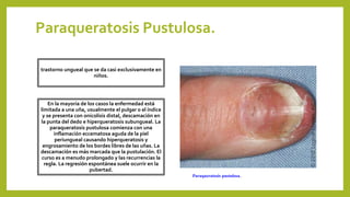 Paraqueratosis Pustulosa.
trastorno ungueal que se da casi exclusivamente en
niños.
En la mayoria de los casos la enfermedad está
limitada a una uña, usualmente el pulgar o el índice
y se presenta con onicolisis distal, descamación en
la punta del dedo e hiperqueratosis subungueal. La
paraqueratosis pustulosa comienza con una
inflamación eccematosa aguda de la piel
periungueal causando hiperqueratosis y
engrosamiento de los bordes libres de las uñas. La
descamación es más marcada que la pustulación. El
curso es a menudo prolongado y las recurrencias la
regla. La regresión espontánea suele ocurrir en la
pubertad.
Paraqueratosis pustulosa.
 