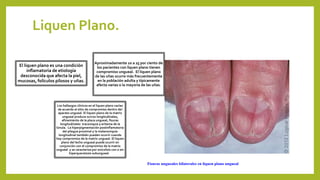 Liquen Plano.
Fisuras ungueales bilaterales en liquen plano ungueal
El liquen plano es una condición
inflamatoria de etiología
desconocida que afecta la piel,
mucosas, folículos pilosos y uñas.
Aproximadamente 10 a 25 por ciento de
los pacientes con liquen plano tienen
compromiso ungueal. El liquen plano
de las uñas ocurre más frecuentemente
en la población adulta y típicamente
afecta varias o la mayoría de las uñas.
Los hallazgos clínicos en el liquen plano varían
de acuerdo al sitio de compromiso dentro del
aparato ungueal. El liquen plano de la matriz
ungueal produce surcos longitudinales,
afinamiento de la placa ungueal, fisuras
longitudinales traconiquia y eritema de la
lúnula. La hiperpigmentación postinflamatoria
del pliegue proximal y la melanoniquia
longitudinal también pueden ocurrir cuando
hay compromiso de la matriz ungueal. El liquen
plano del lecho ungueal puede ocurrir en
conjunción con el compromiso de la matriz
ungueal y se caracteriza por onicolisis con o sin
hiperqueratosis subungueal.
 