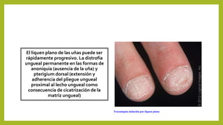 El liquen plano de las uñas puede ser
rápidamente progresivo. La distrofia
ungueal permanente en las formas de
anoniquia (ausencia de la uña) y
pterigium dorsal (extensión y
adherencia del pliegue ungueal
proximal al lecho ungueal como
consecuencia de cicatrización de la
matriz ungueal)
Traconiquia inducida por liquen plano
 