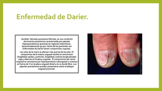 Enfermedad de Darier.
también llamada queratosis folicular, es una condición
dominante autosómica caracterizada por pápulas
hiperqueratósicas grasosas en regiones seborreicas.
Aproximadamente 90 por ciento de los pacientes con
enfermedad de Darier tienen compromiso ungueal.
Las uñas de la mano se afectan más que las de los pies. El
compromiso de la matriz ungueal resulta en onicorrexis
(fragilidad capilar), partición, fragilidad y estrías longitudinales
rojas y blancas en la placa ungueal. El compromiso del lecho
ungueal se caracteriza por hiperqueratosis subungueal y muescas
en forma de V en la placa ungueal distal y en su borde libre. Las
pápulas queratósicas pueden presentarse sobre el pliegue
ungueal proximal.
 