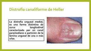 Distrofia canaliforme de Heller
La distrofia ungueal medial,
es una forma distintiva de
surco longitudinal
caracterizado por un canal
paramediano o partición de la
lámina ungueal de una o más
uñas
 