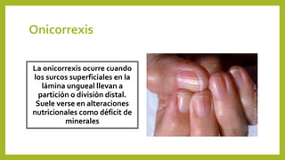 Onicorrexis
La onicorrexis ocurre cuando
los surcos superficiales en la
lámina ungueal llevan a
partición o división distal.
Suele verse en alteraciones
nutricionales como déficit de
minerales
 