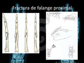 Lesiones del metacarpo jalil | PPTX