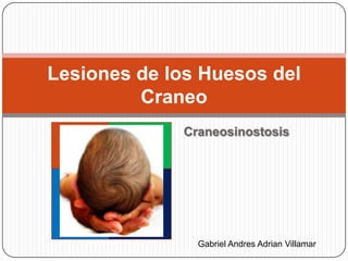 Lesiones de los Huesos del
         Craneo
             Craneosinostosis




               Gabriel Andres Adrian Villamar
 