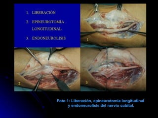Foto 1: Liberación, epineurotomía longitudinal  y endoneurolisis del nervio cubital. 