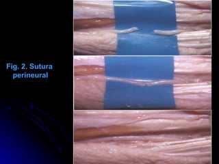                                                                                                   Fig. 2. Sutura perineural 