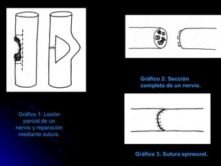 Gráfico 1: Lesión parcial de un nervio y reparación mediante sutura. Gráfico 2: Sección completa de un nervio. Gráfico 3: Sutura epineural. 