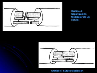 Gráfico 4: Organización fascicular de un nervio. Gráfico 5: Sutura fascicular. 