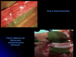 Foto 3: Sutura fascicular. Foto 4: Adhesivo de fibrina para reforzar la sutura fascicular. 