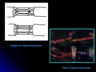 Gráfico 6: Injerto fascicular. Foto 5: Injerto fascicular. 