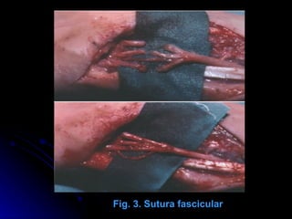                                                                                                  Fig. 3. Sutura fascicular 