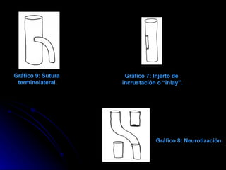Gráfico 7: Injerto de incrustación o “inlay”. Gráfico 8: Neurotización. Gráfico 9: Sutura terminolateral. 