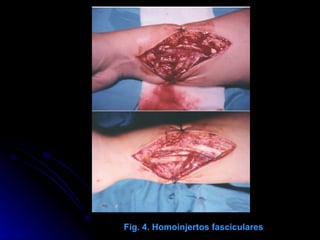                                                                                                  Fig. 4. Homoinjertos fasciculares 