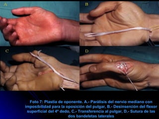 Foto 7: Plastia de oponente. A.- Parálisis del nervio mediano con imposibilidad para la oposición del pulgar, B.- Desinserción del flexor superficial del 4º dedo, C.- Transferencia al pulgar, D.- Sutura de las dos bandeletas laterales 