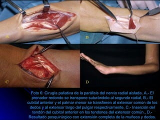 Foto 6: Cirugía paliativa de la parálisis del nervio radial aislada. A.- El pronador redondo se transpone suturándolo al segundo radial, B.- El cubital anterior y el palmar menor se transfieren al extensor común de los dedos y al extensor largo del pulgar respectivamente, C.- Inserción del tendón del cubital anterior en los tendones del extensor común., D.- Resultado posquirúrgico con extensión completa de la muñeca y dedos. 