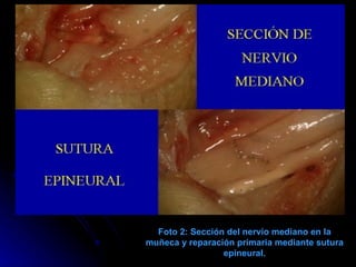 Foto 2: Sección del nervio mediano en la muñeca y reparación primaria mediante sutura epineural. 
