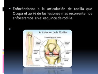  Enfocándonos a la articulación de rodilla que
Ocupa el 20 % de las lesiones mas recurrente nos
enfocaremos en el esguince de rodilla.

 