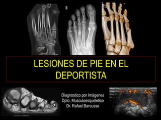 LESIONES DE PIE EN EL
DEPORTISTA
Diagnostico por Imágenes
Dpto. Musculoesqueletico
Dr. Rafael Barousse
 