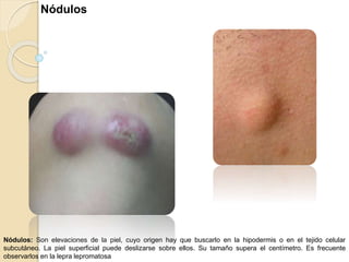 Lesiones de piel (primarias y secundarias) | PPTX