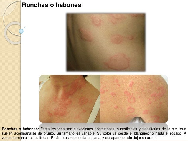 Lesiones de piel (primarias y secundarias)