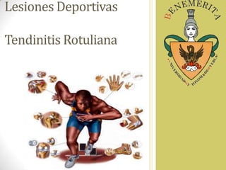 Lesiones Deportivas
Tendinitis Rotuliana

 