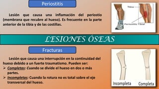 LESIONES ÓSEAS
Periostitis
Fracturas
Lesión que causa una inflamación del periostio
(membrana que recubre al hueso). Es frecuente en la parte
anterior de la tibia y de las costillas.
Lesión que causa una interrupción en la continuidad del
hueso debido a un fuerte traumatismo. Pueden ser:
➢ Completas: Cuando se divide el hueso en dos o más
partes.
➢ Incompletas: Cuando la rotura no es total sobre el eje
transversal del hueso.
 