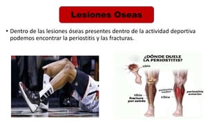 • Dentro de las lesiones óseas presentes dentro de la actividad deportiva
podemos encontrar la periostitis y las fracturas.
Lesiones Oseas
 