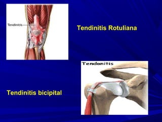 Tendinitis Rotuliana
Tendinitis bicipital
 