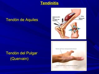 TendinitisTendinitis
Tendón de AquilesTendón de Aquiles
Tendón del PulgarTendón del Pulgar
(Quervain)(Quervain)
 
