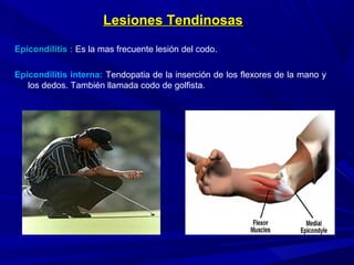 Lesiones TendinosasLesiones Tendinosas
Epicondilitis :Epicondilitis : Es la mas frecuente lesión del codo.
Epicondilitis interna: Tendopatia de la inserción de los flexores de la mano y
los dedos. También llamada codo de golfista.
 