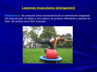 Lesiones musculares (elongaciónLesiones musculares (elongación))
Distensiones: Se producen como consecuencia de un estiramiento exagerado
del músculo pero sin llegar a una ruptura, se produce inflamación y aparece el
dolor. Se conoce como tirón muscular.
 