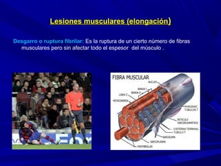 Lesiones musculares (elongaciónLesiones musculares (elongación))
Desgarro o ruptura fibrilar: Es la ruptura de un cierto número de fibras
musculares pero sin afectar todo el espesor del músculo .
 