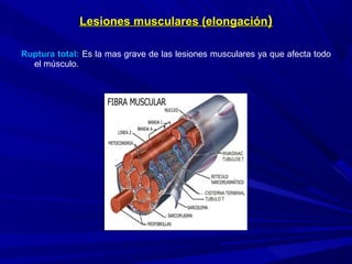 Lesiones musculares (elongaciónLesiones musculares (elongación))
Ruptura total: Es la mas grave de las lesiones musculares ya que afecta todo
el músculo.
 