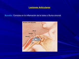 Lesiones ArticularesLesiones Articulares
Bursitis: Consiste en la inflamación de la bolsa o Bursa sinovial.
 