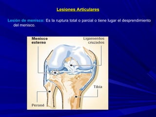 Lesiones ArticularesLesiones Articulares
Lesión de menisco: Es la ruptura total o parcial o tiene lugar el desprendimiento
del menisco.
 