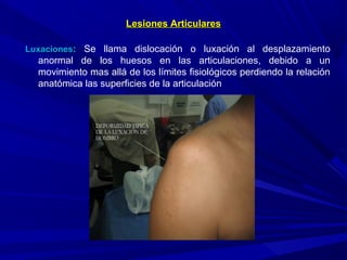 Lesiones ArticularesLesiones Articulares
LuxacionesLuxaciones:: Se llama dislocación o luxación al desplazamiento
anormal de los huesos en las articulaciones, debido a un
movimiento mas allá de los límites fisiológicos perdiendo la relación
anatómica las superficies de la articulación
 