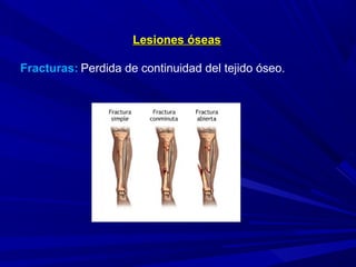 Lesiones óseasLesiones óseas
Fracturas: Perdida de continuidad del tejido óseo.
 